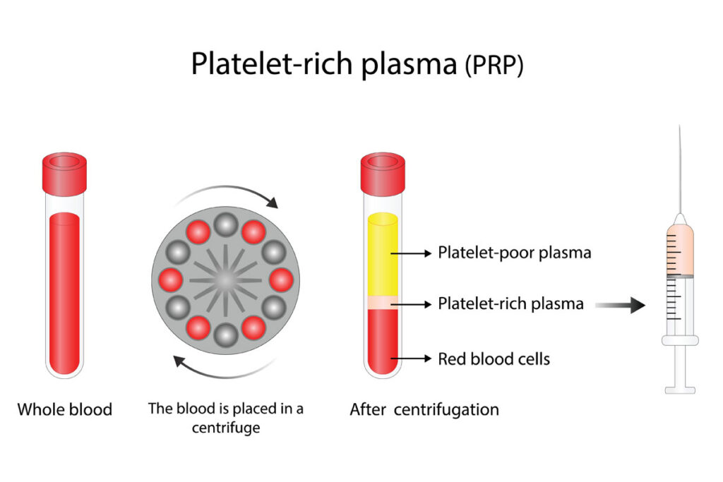 PRP Platelet-Rich Plasma