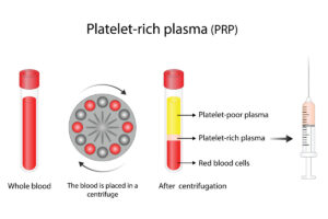 PRP Platelet-Rich Plasma